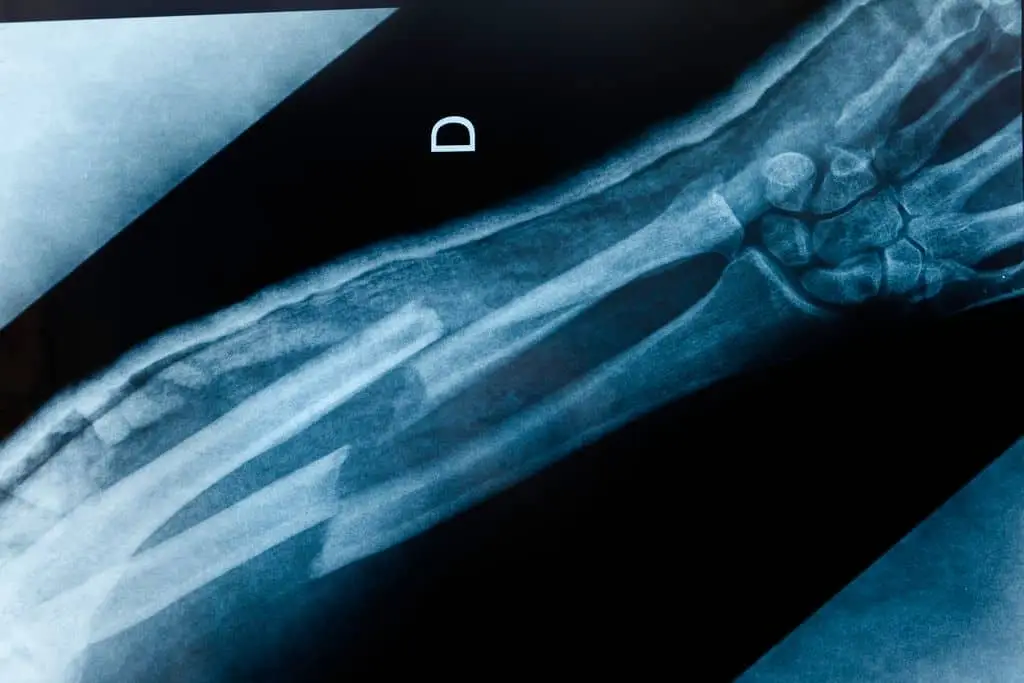 n x-ray showing two broken bones in the arm of a slip-and-fall victim