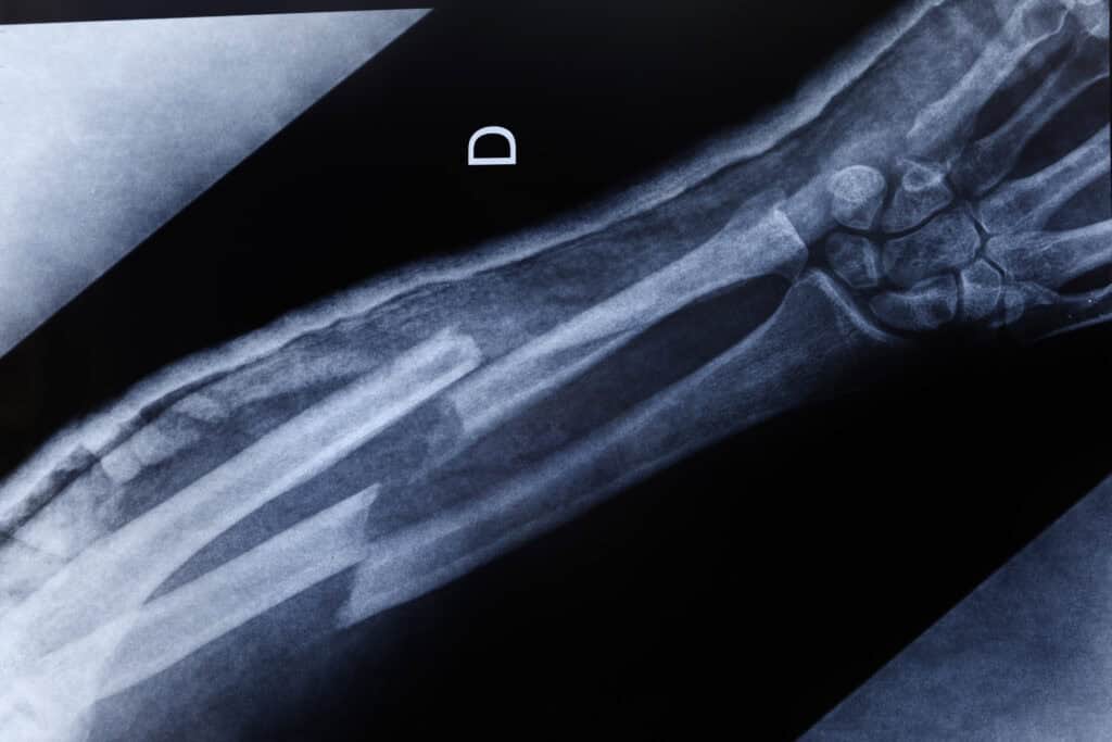 An X-ray image of a broken arm after a car accident.